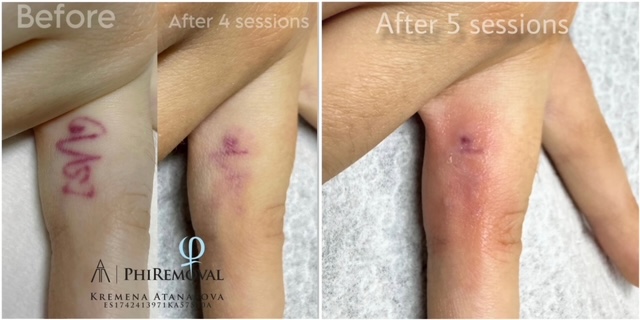 PhiRemoval — детайл
